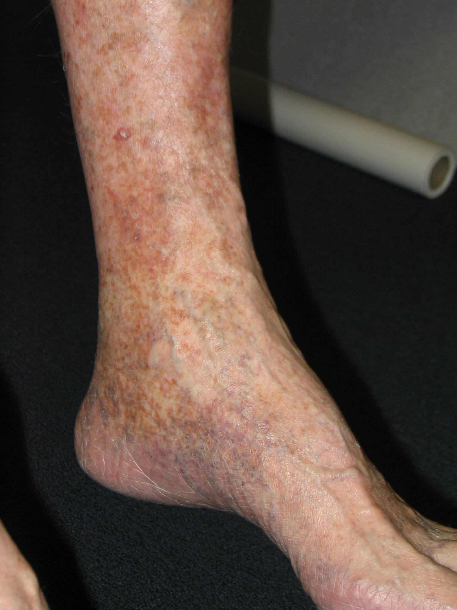 Skin Discoloration On Feet And Ankles